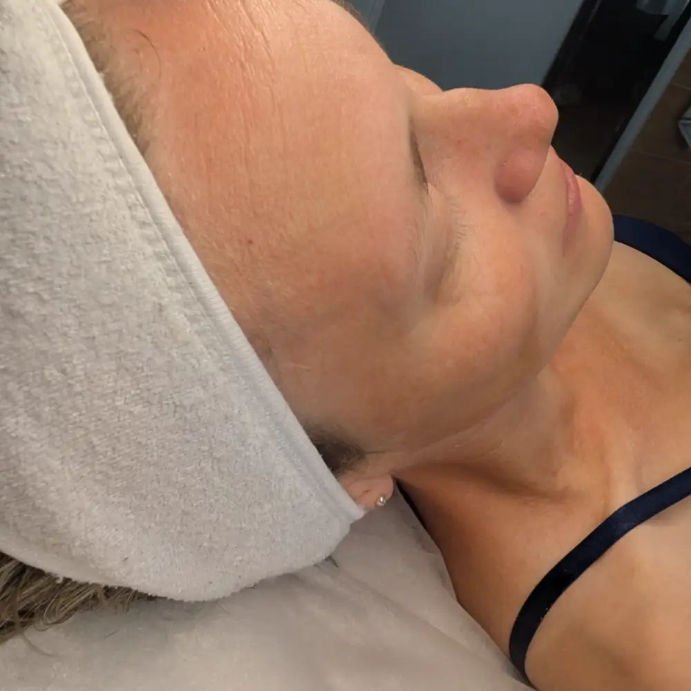 Pred ošetrením: ABR PRO – biorevitalizačné ošetrenie – Klientka, 38 r. — po prvom sedení