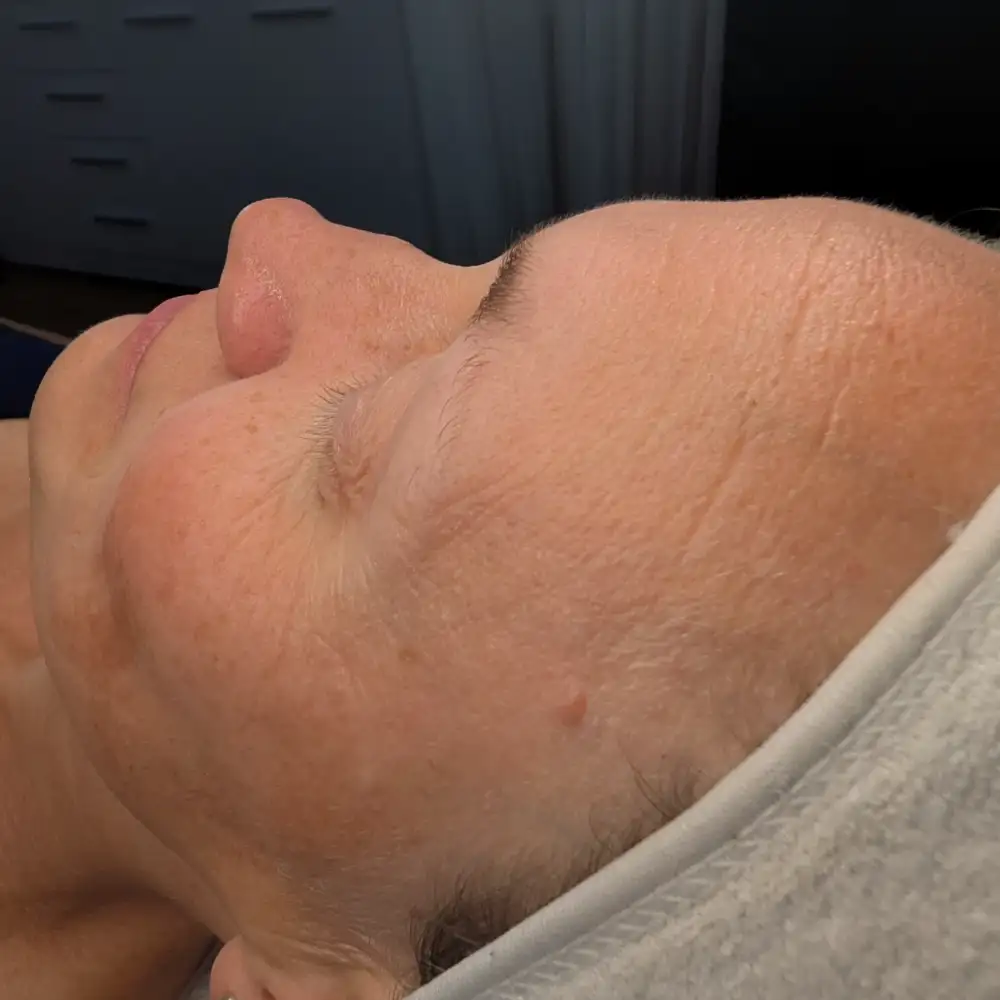 Pred ošetrením: ABR PRO – biorevitalizačné ošetrenie – Klientka, 38 r. — po prvom sedení (2. pohľad)
