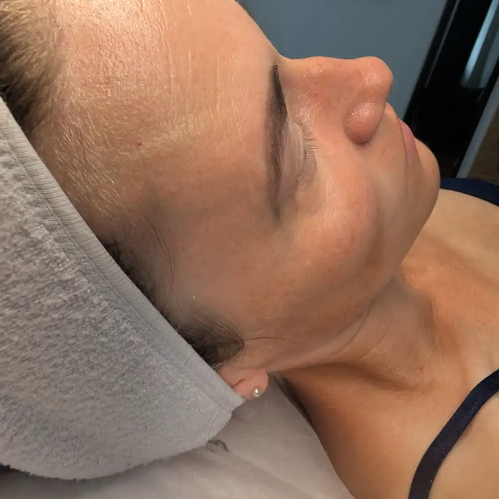 Po ošetrení: ABR PRO – biorevitalizačné ošetrenie – Klientka, 38 r. — po prvom sedení