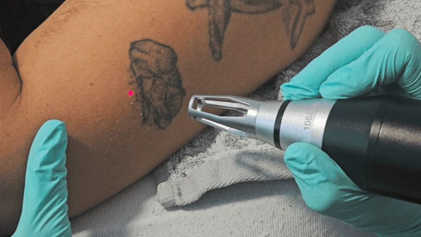 Odstraňovanie tetovania