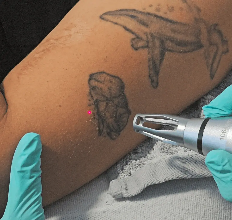 Odstránenie tetovania